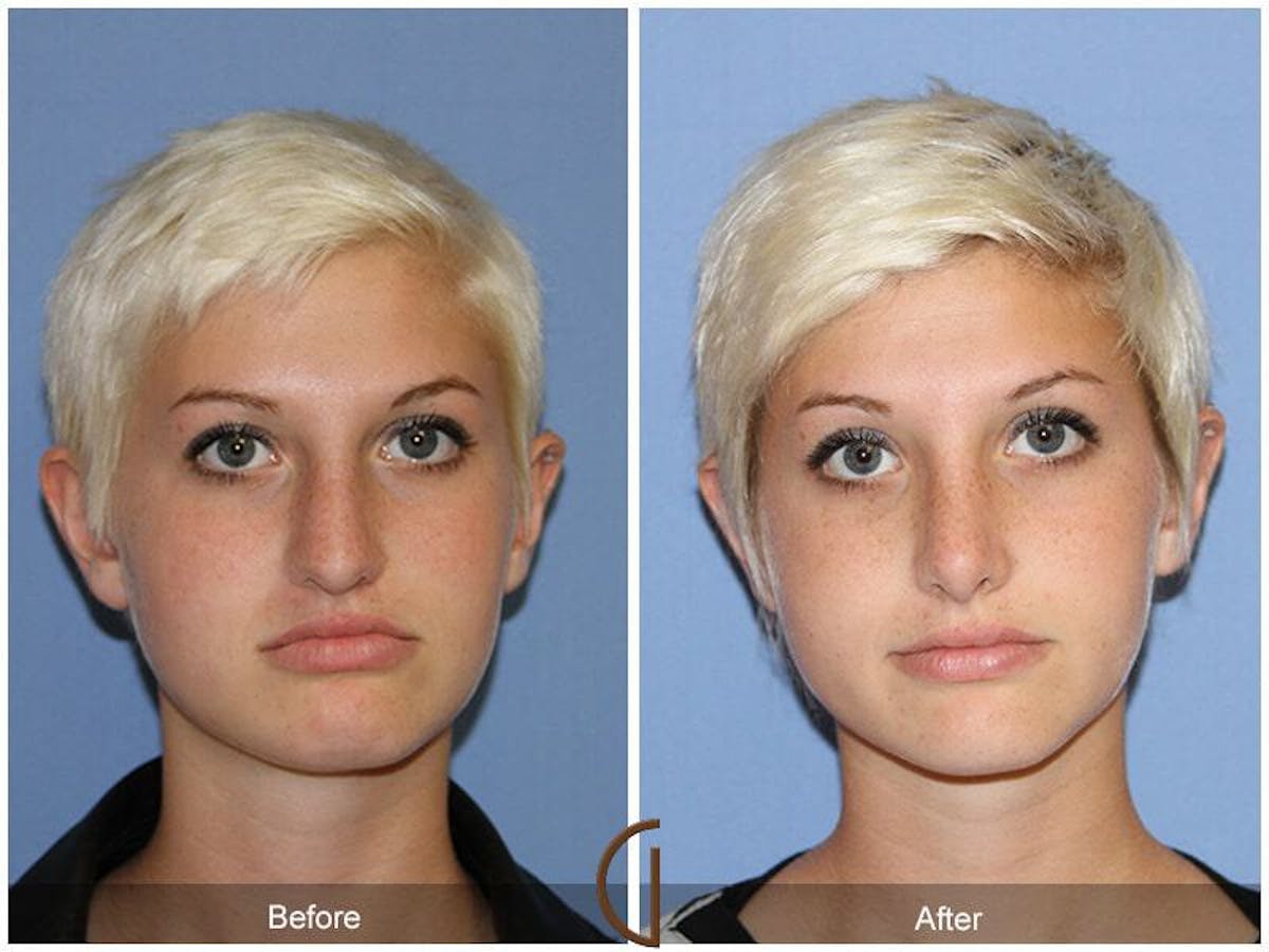 Rhinoplasty Before & After Gallery - Patient 110794 - Image 2