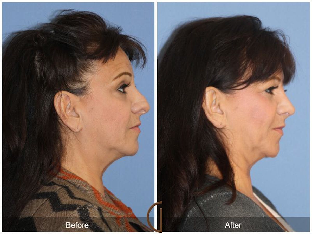 Female Rhinoplasty Before & After Gallery - Patient 264469 - Image 3