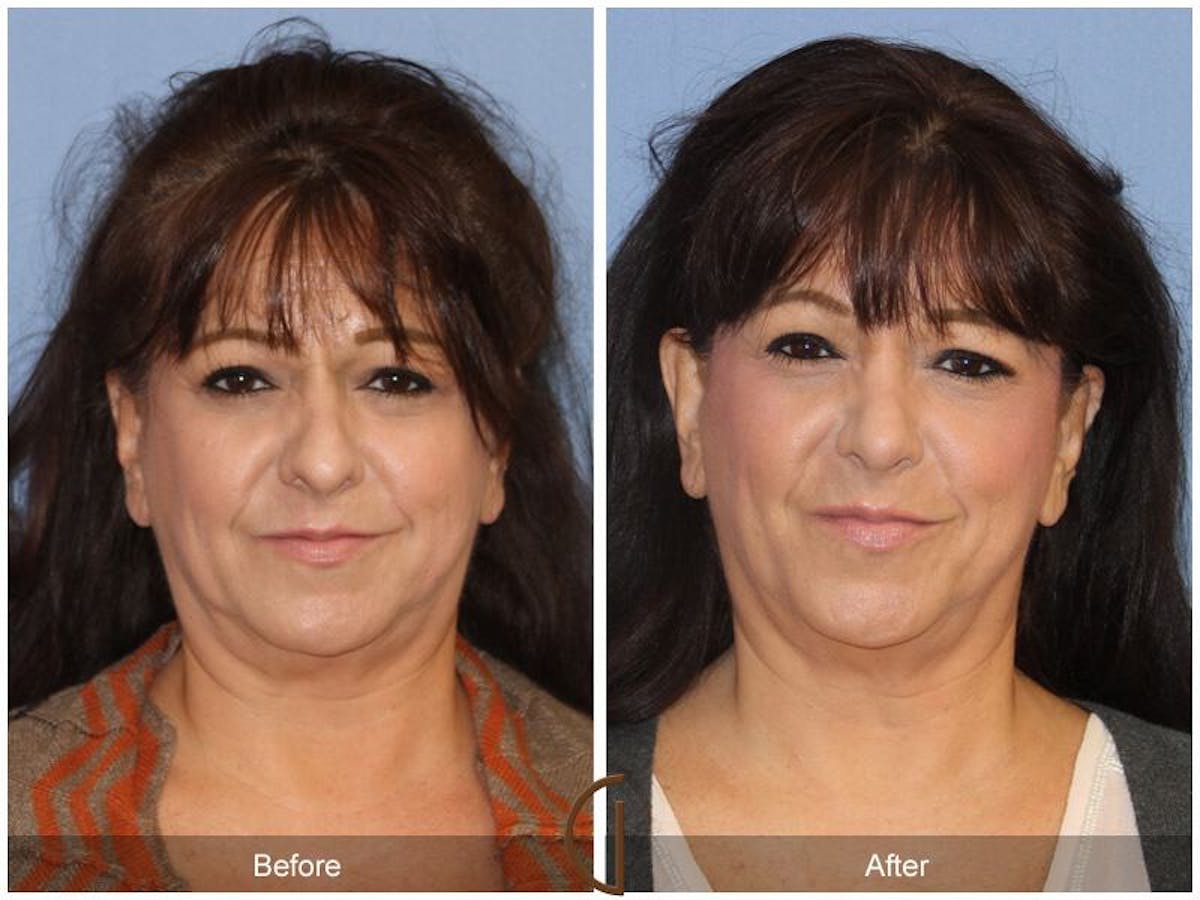 Female Rhinoplasty Before & After Gallery - Patient 264469 - Image 2