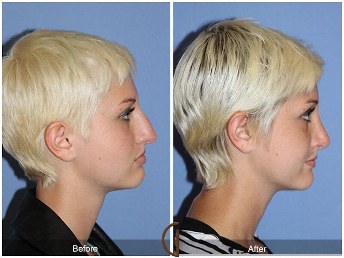Rhinoplasty Before & After Gallery - Patient 110794 - Image 3