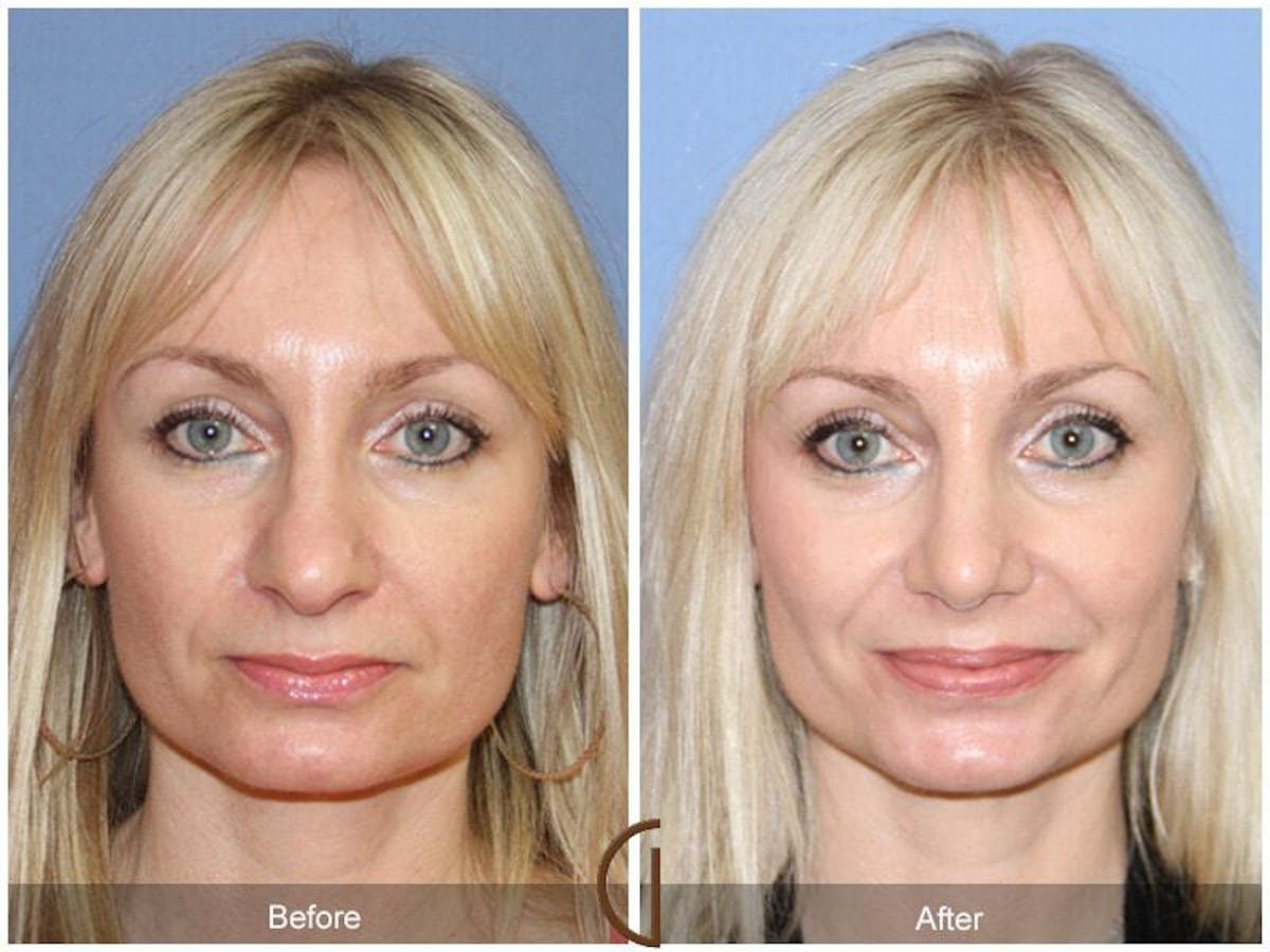 Female Rhinoplasty Before & After Gallery - Patient 815571 - Image 2