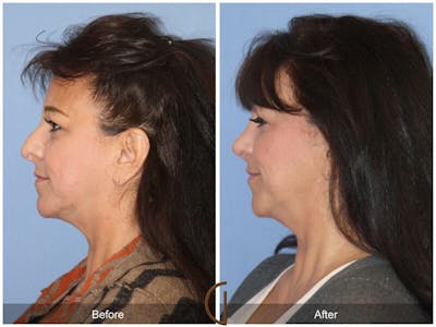 Female Rhinoplasty Before & After Gallery - Patient 264469 - Image 1