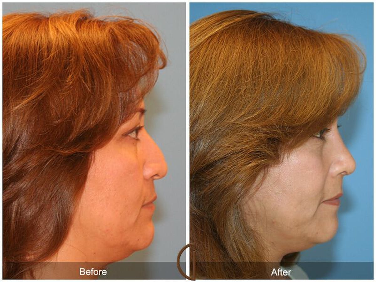 Revision Rhinoplasty Before & After Gallery - Patient 319180 - Image 3