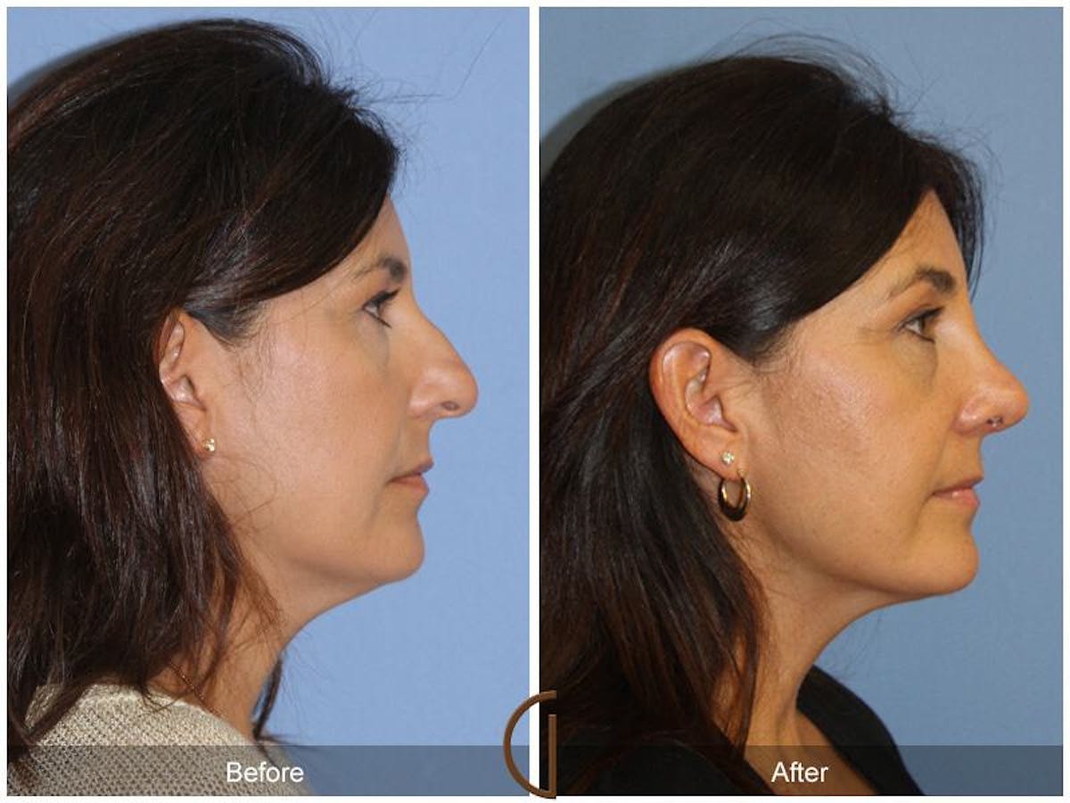 Female Rhinoplasty Before & After Gallery - Patient 335297 - Image 3