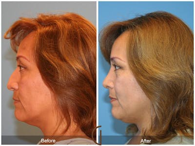 Revision Rhinoplasty Before & After Gallery - Patient 319180 - Image 1