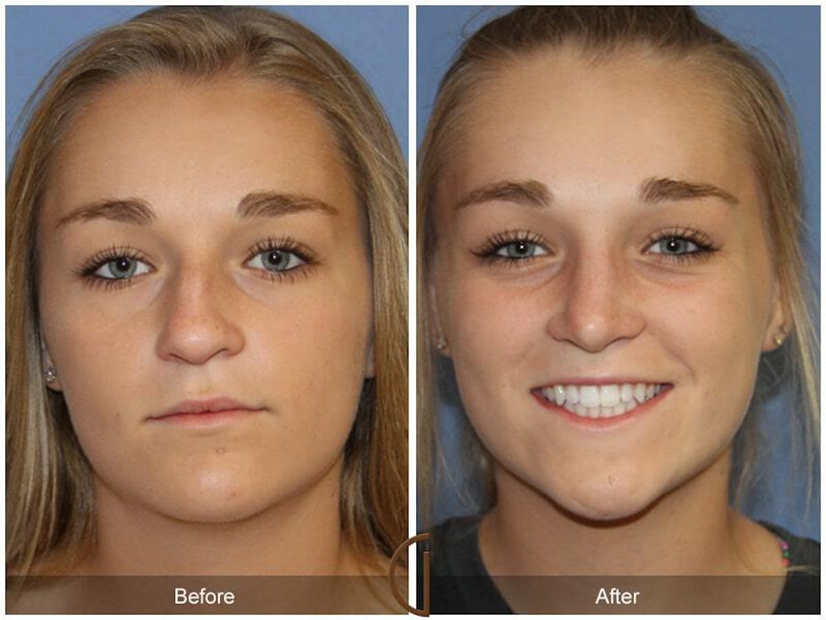 Female Rhinoplasty Before & After Gallery - Patient 261554 - Image 2