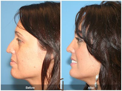 Female Rhinoplasty Before & After Gallery - Patient 282833 - Image 1