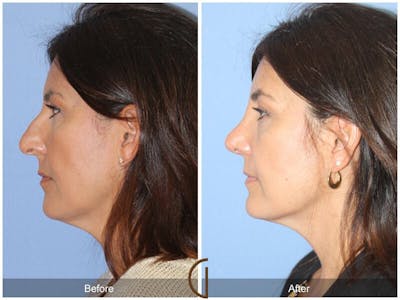 Female Rhinoplasty Before & After Gallery - Patient 335297 - Image 1