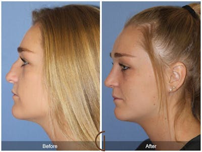 Female Rhinoplasty Before & After Gallery - Patient 261554 - Image 1