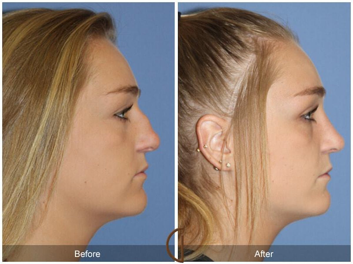 Female Rhinoplasty Before & After Gallery - Patient 261554 - Image 3
