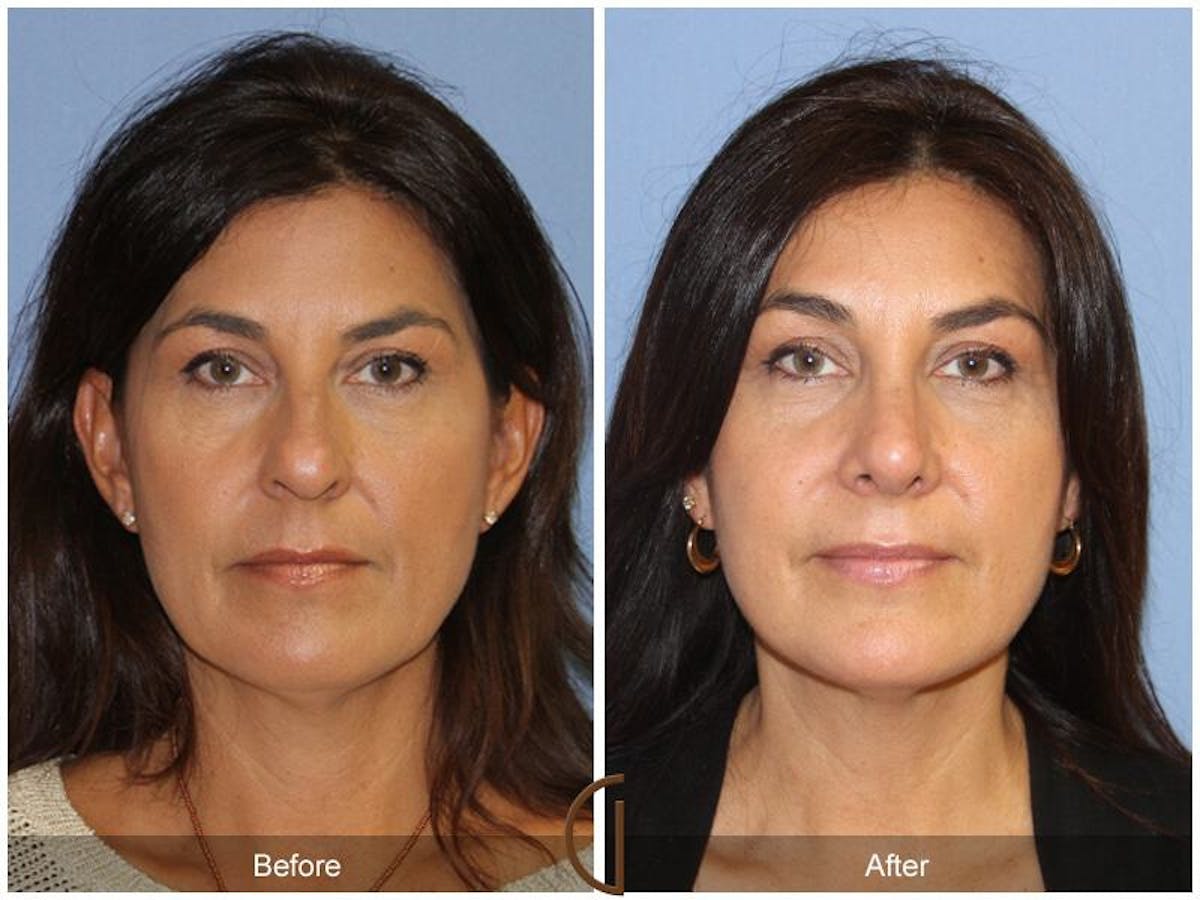 Female Rhinoplasty Before & After Gallery - Patient 335297 - Image 2