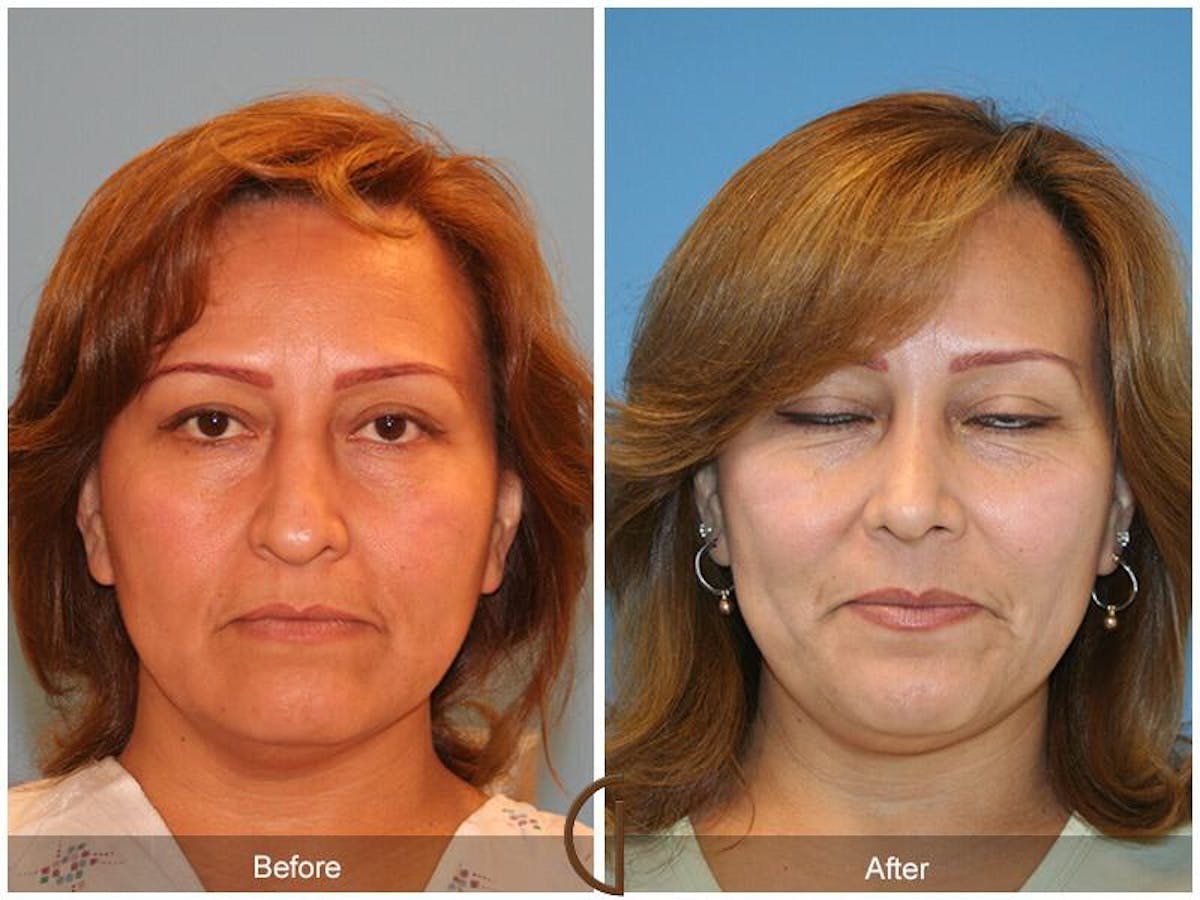Revision Rhinoplasty Before & After Gallery - Patient 319180 - Image 2