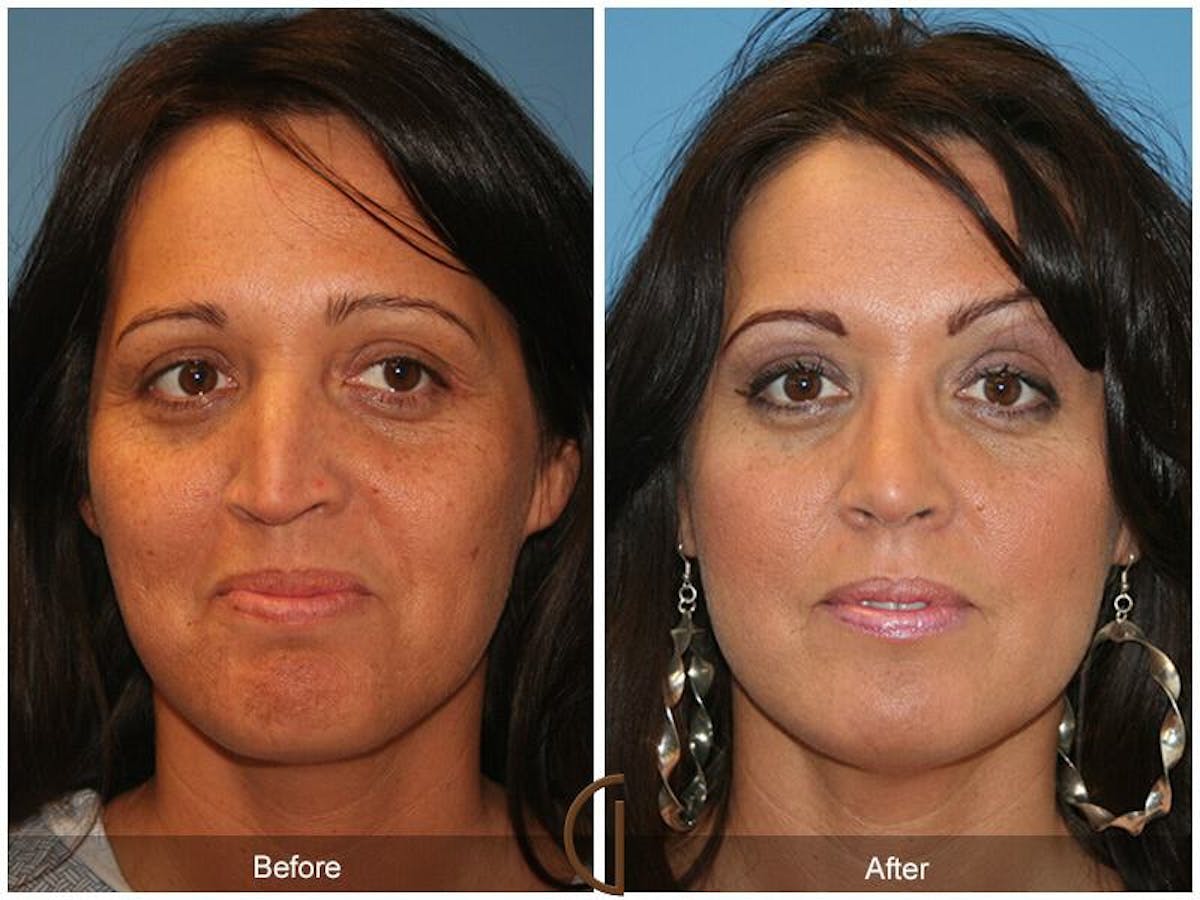 Female Rhinoplasty Before & After Gallery - Patient 282833 - Image 2