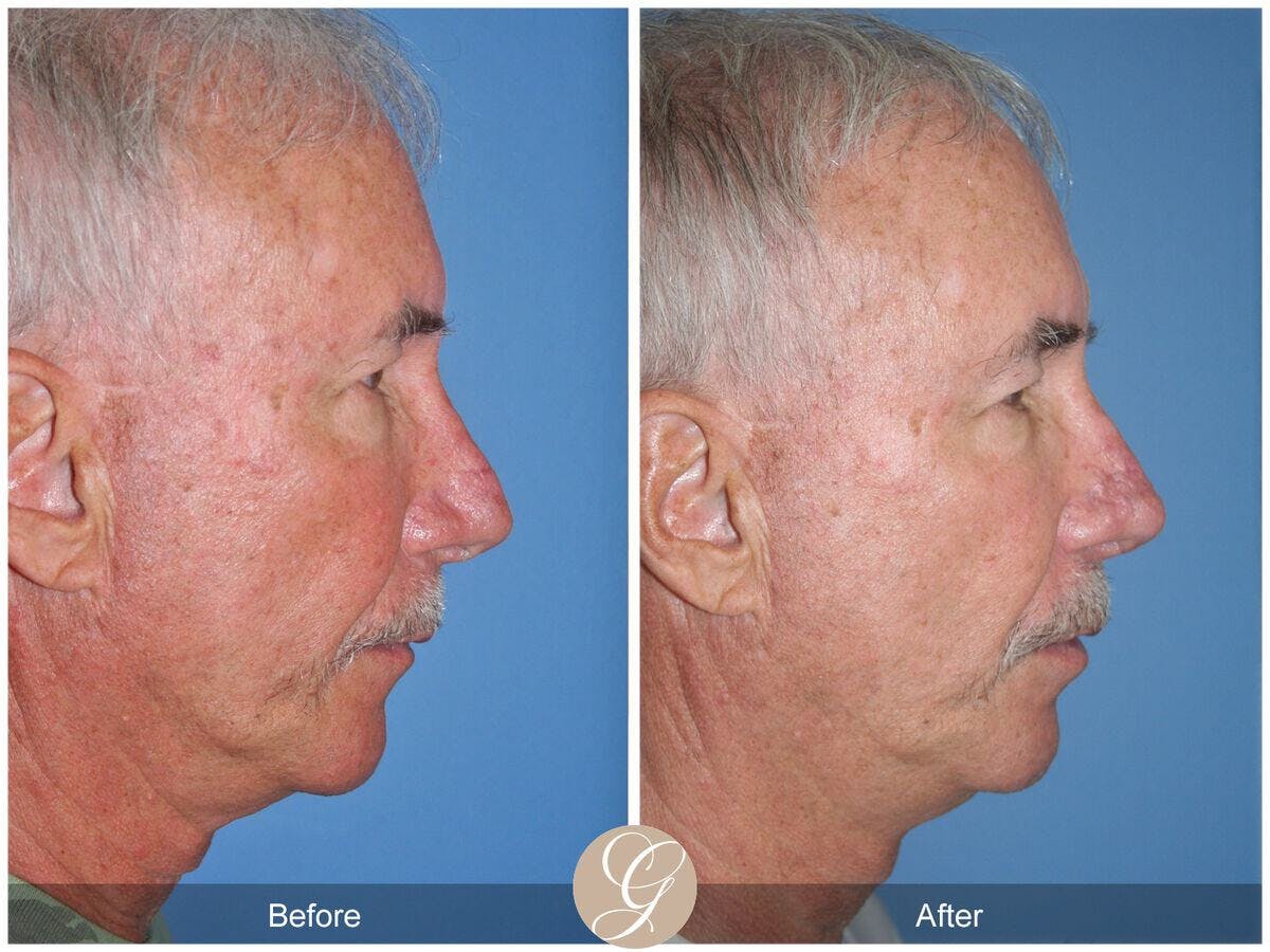 Rhinoplasty Before & After Gallery - Patient 105670 - Image 3