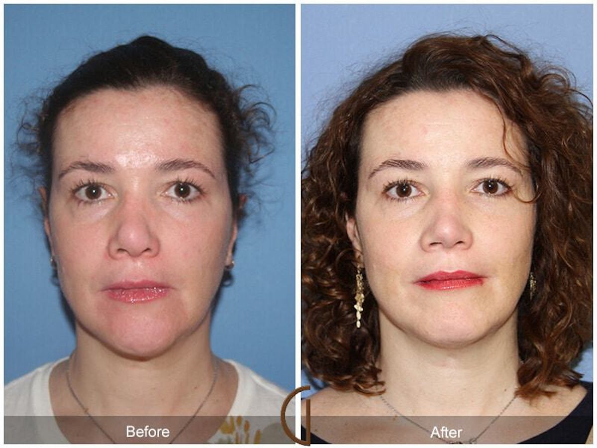 Female Rhinoplasty Before & After Gallery - Patient 127886 - Image 2