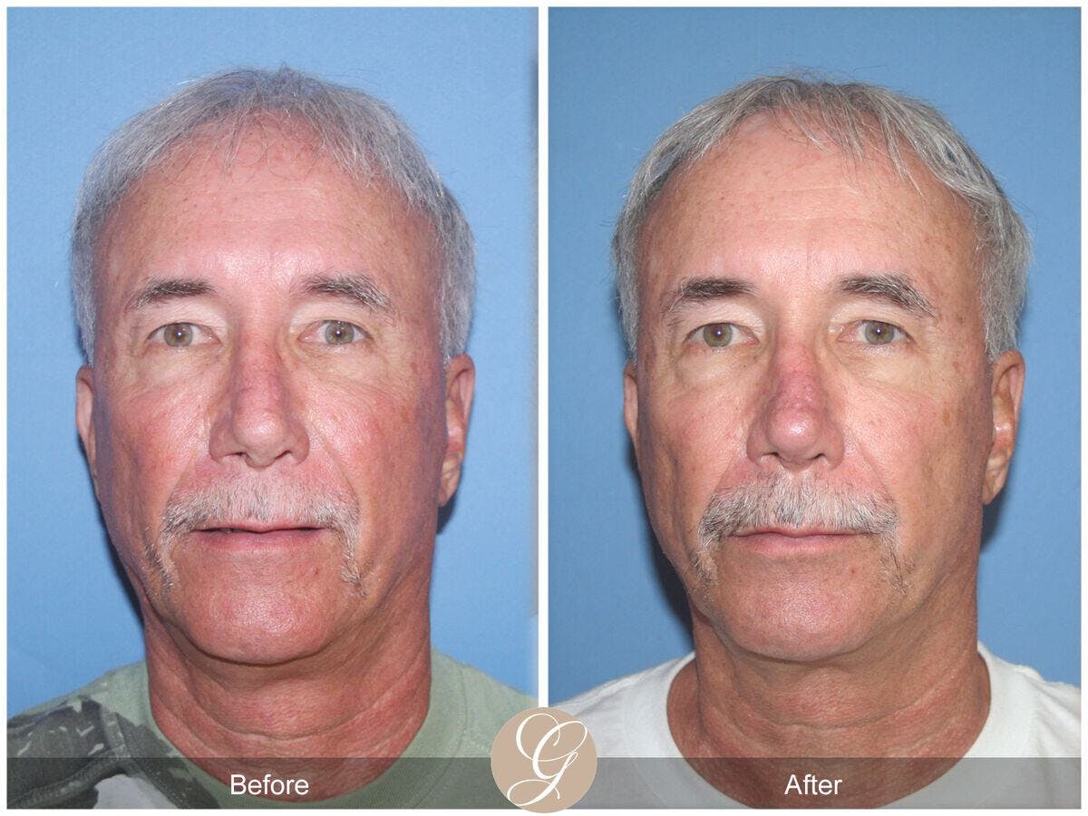 Rhinoplasty Before & After Gallery - Patient 105670 - Image 2