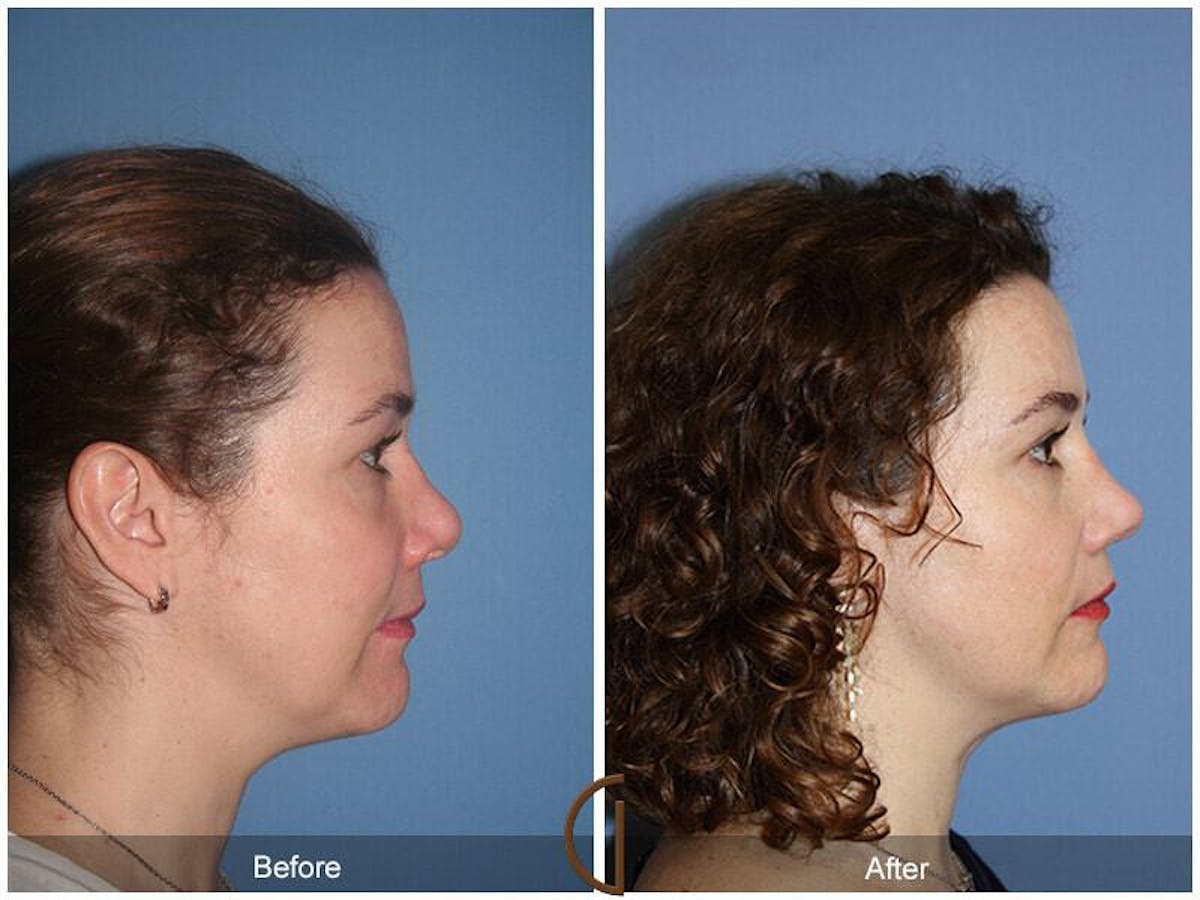 Female Rhinoplasty Before & After Gallery - Patient 127886 - Image 3