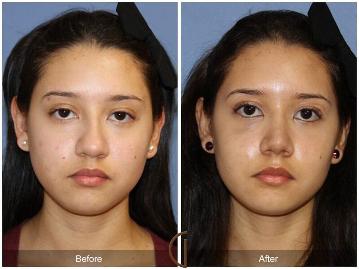 Female Rhinoplasty Before & After Gallery - Patient 157714 - Image 2