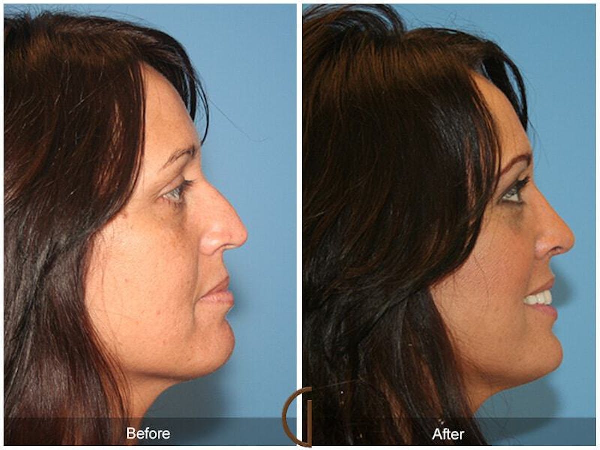 Female Rhinoplasty Before & After Gallery - Patient 282833 - Image 3