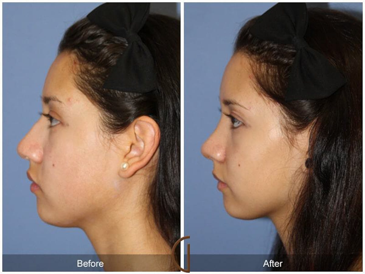 Female Rhinoplasty Before & After Gallery - Patient 157714 - Image 1