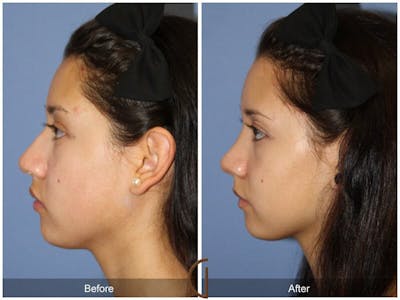 Female Rhinoplasty Before & After Gallery - Patient 157714 - Image 1