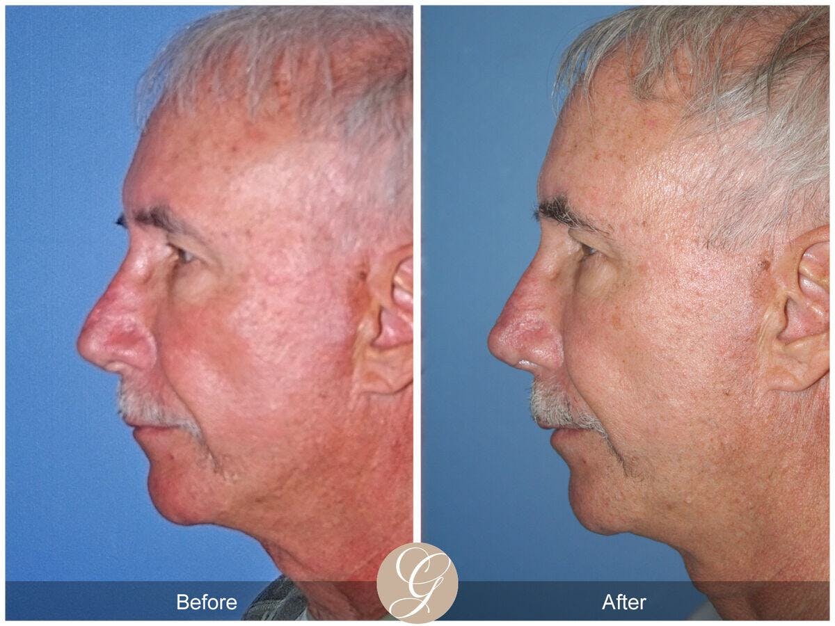 Rhinoplasty Before & After Gallery - Patient 105670 - Image 1
