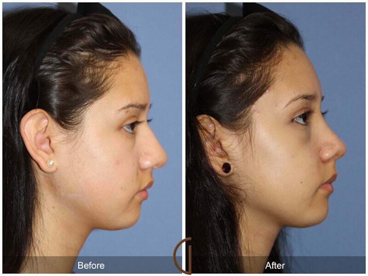 Female Rhinoplasty Before & After Gallery - Patient 157714 - Image 3
