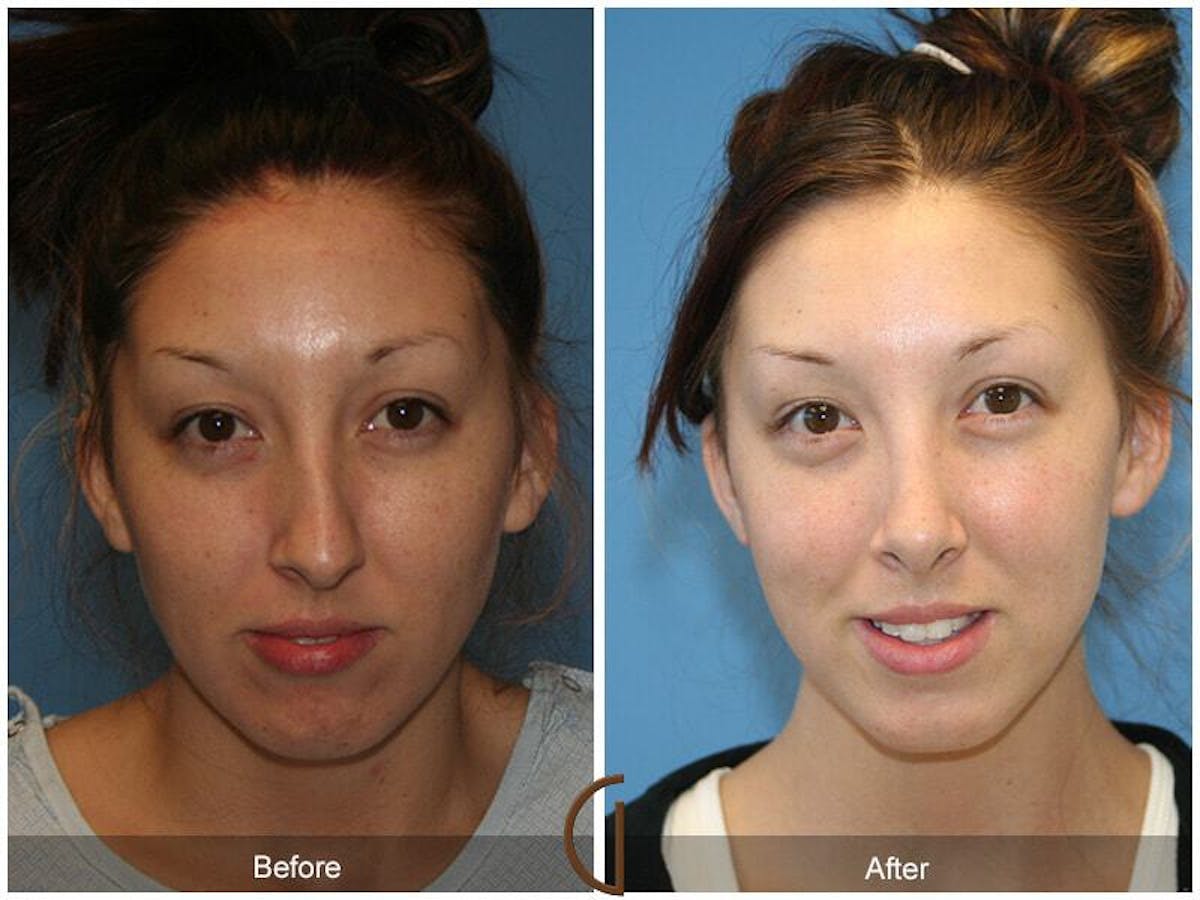 Female Rhinoplasty Before & After Gallery - Patient 891184 - Image 2