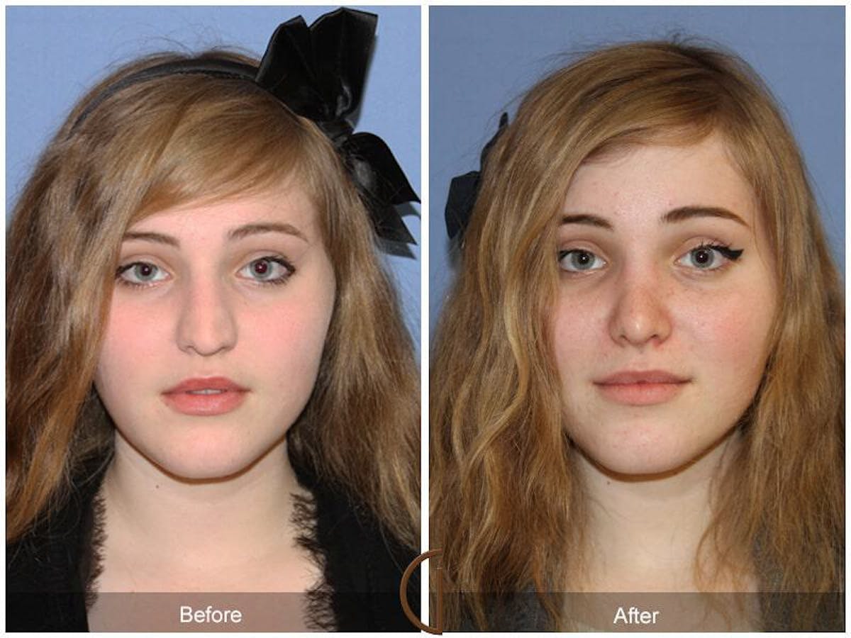 Female Rhinoplasty Before & After Gallery - Patient 116364 - Image 2