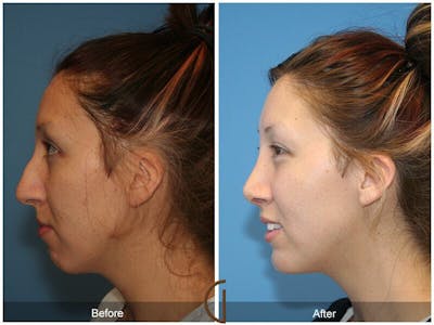 Female Rhinoplasty Before & After Gallery - Patient 891184 - Image 1