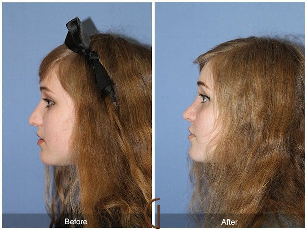 Female Rhinoplasty Before & After Gallery - Patient 116364 - Image 1
