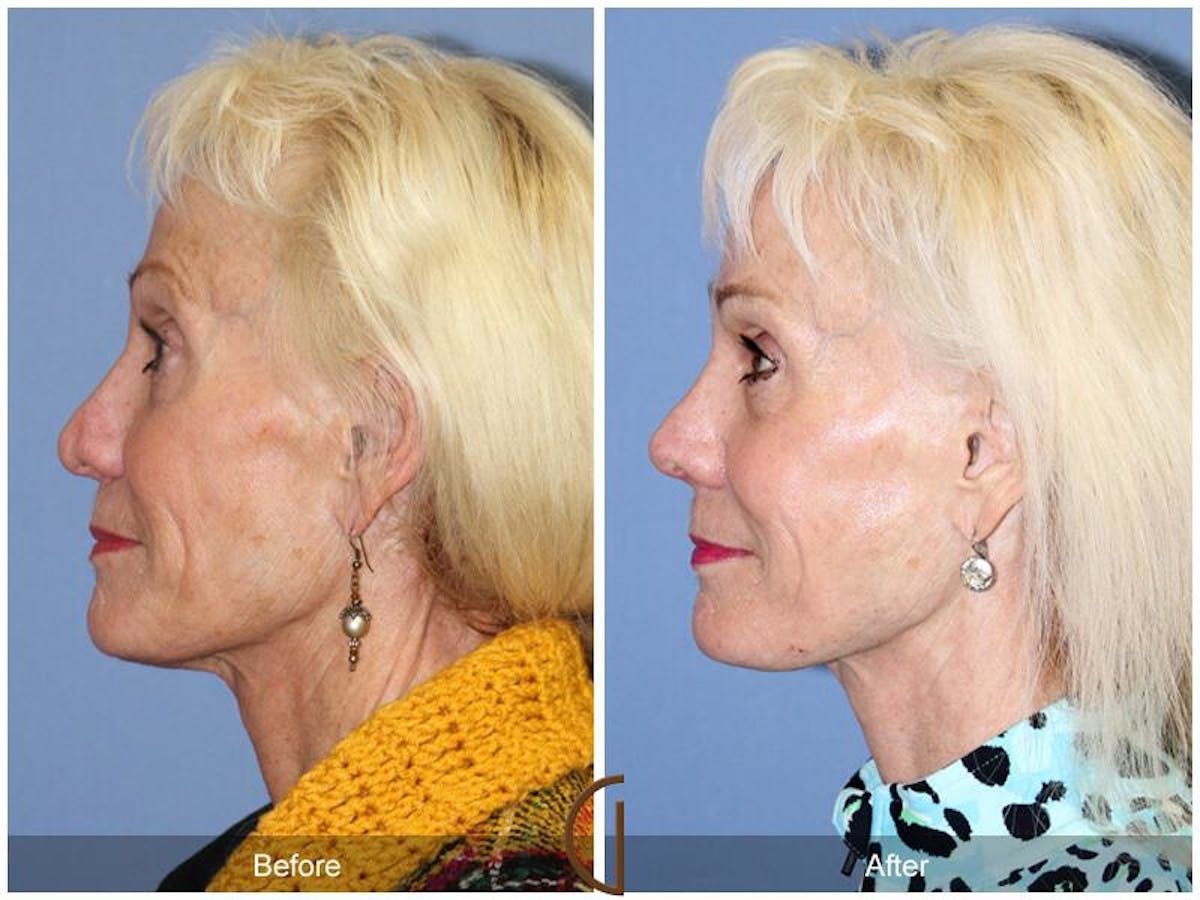 Female Rhinoplasty Before & After Gallery - Patient 112555 - Image 1