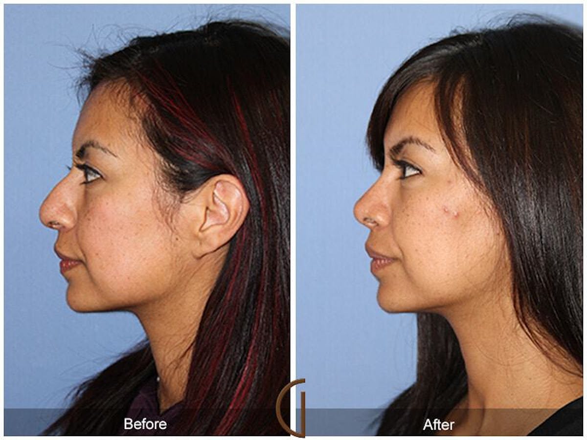 Female Rhinoplasty Before & After Gallery - Patient 169047 - Image 1