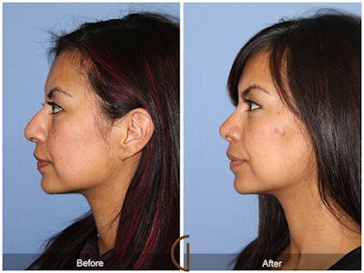 Female Rhinoplasty Before & After Gallery - Patient 169047 - Image 1
