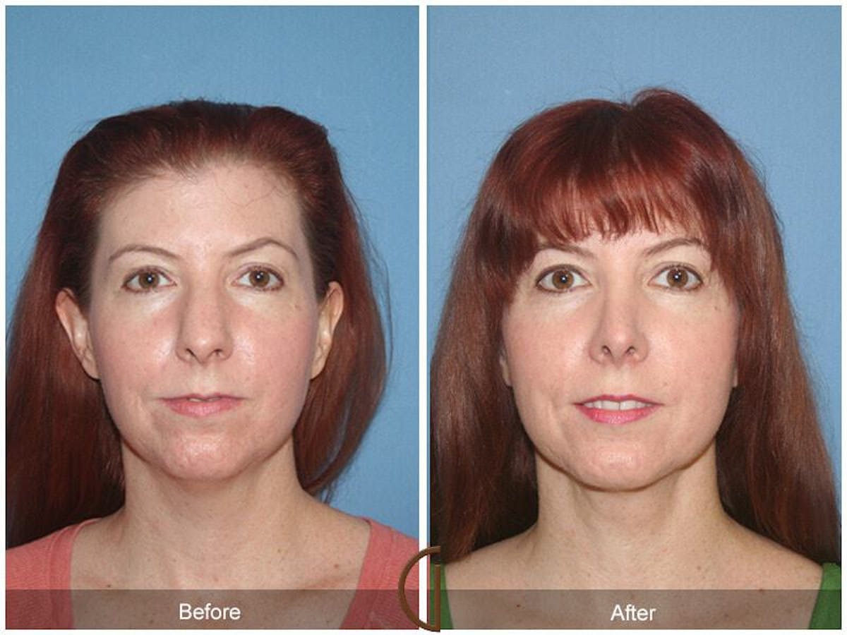 Female Rhinoplasty Before & After Gallery - Patient 312898 - Image 2