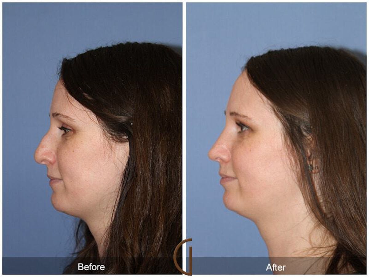 Female Rhinoplasty Before & After Gallery - Patient 386922 - Image 1