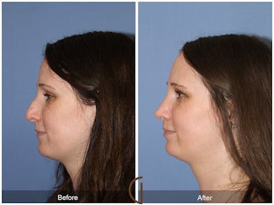 Female Rhinoplasty Before & After Gallery - Patient 386922 - Image 1