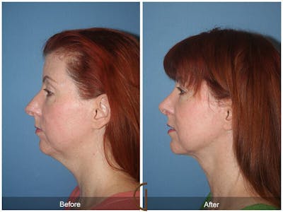 Female Rhinoplasty Before & After Gallery - Patient 312898 - Image 1