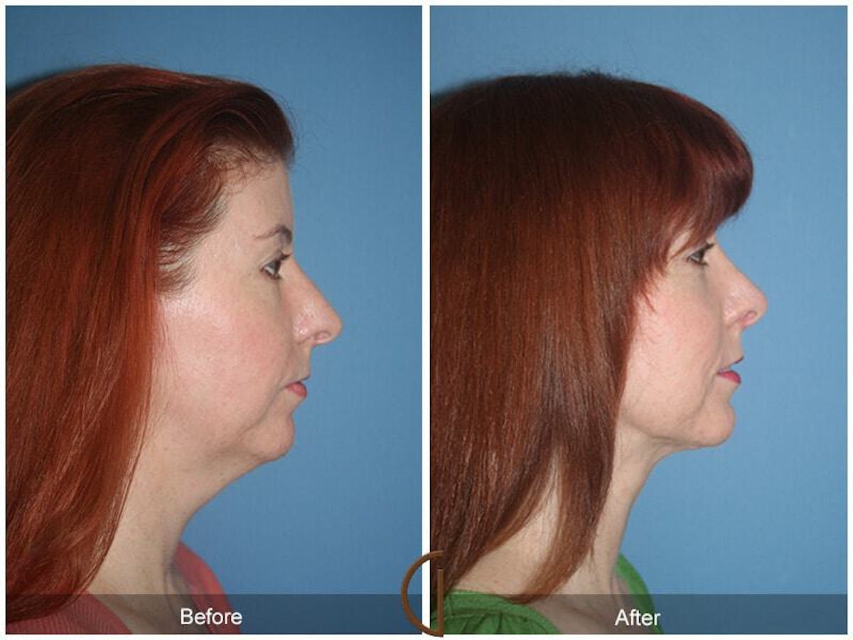 Female Rhinoplasty Before & After Gallery - Patient 312898 - Image 3