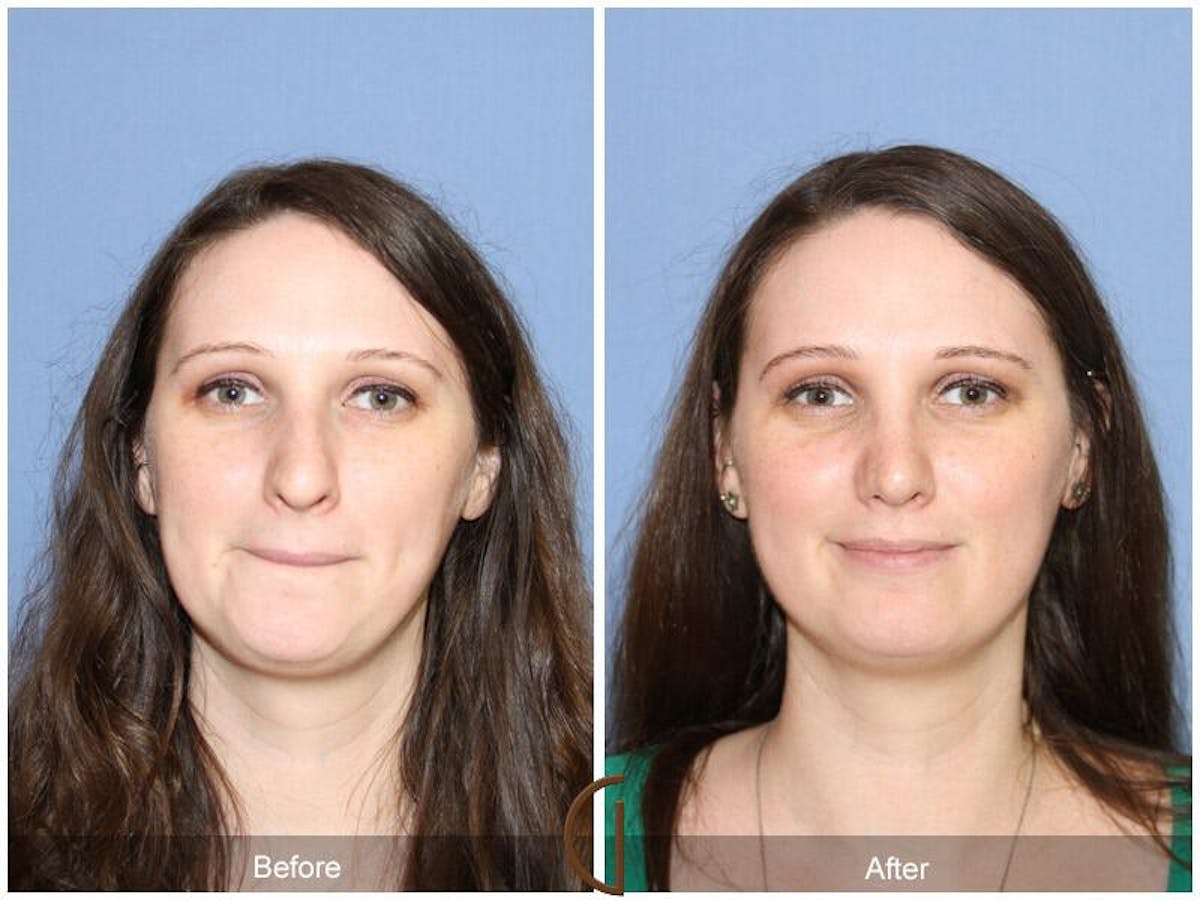 Female Rhinoplasty Before & After Gallery - Patient 386922 - Image 2