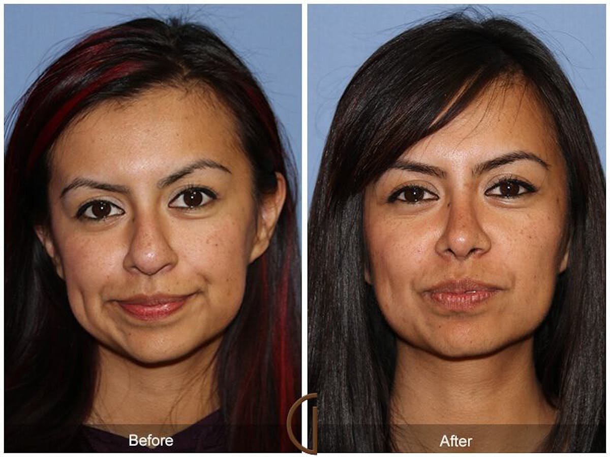 Female Rhinoplasty Before & After Gallery - Patient 169047 - Image 2