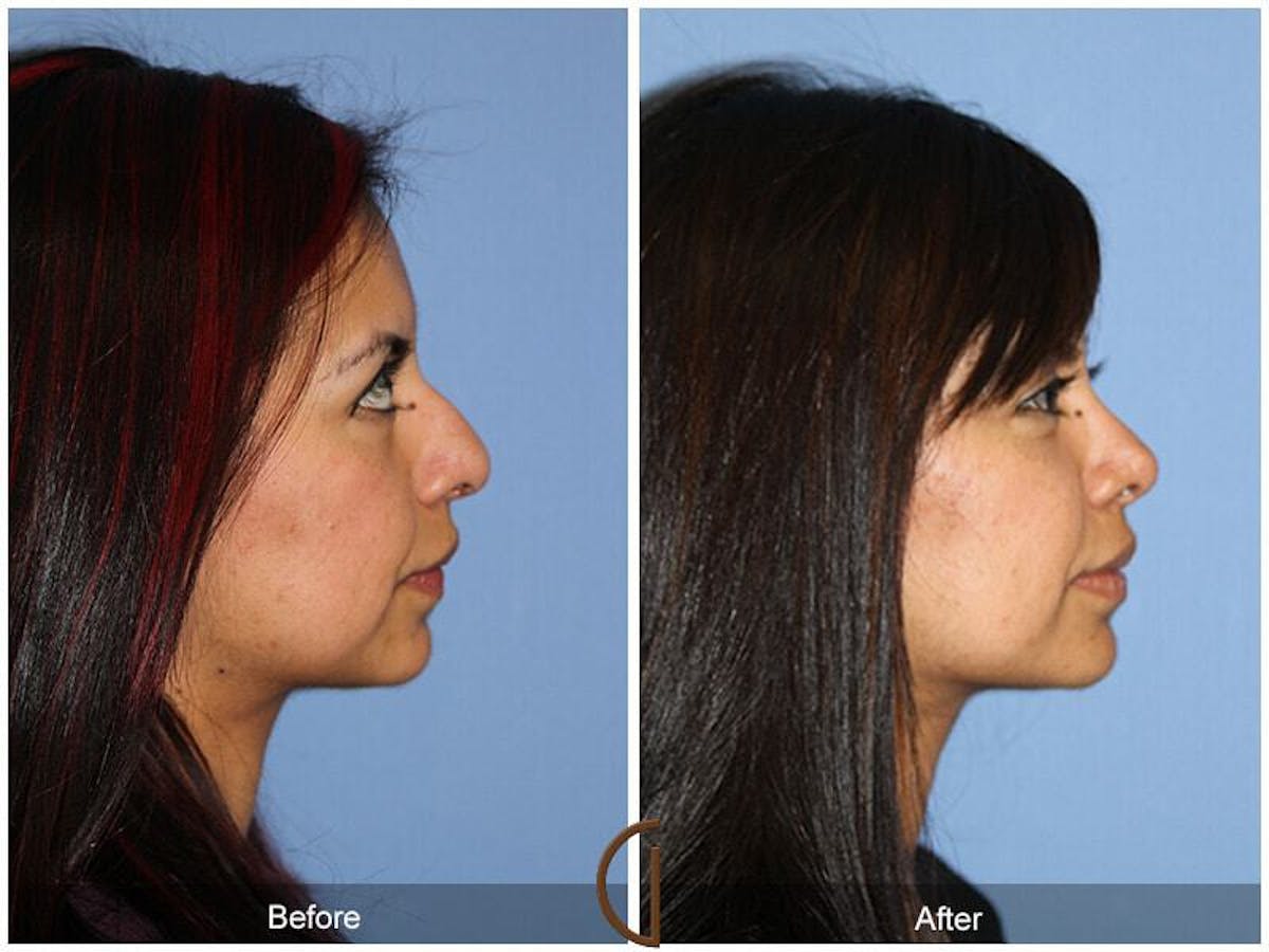 Female Rhinoplasty Before & After Gallery - Patient 169047 - Image 3