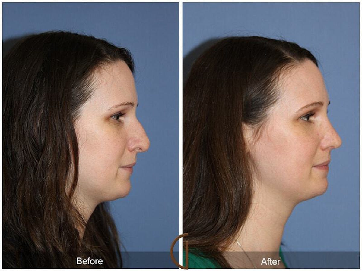 Female Rhinoplasty Before & After Gallery - Patient 386922 - Image 3