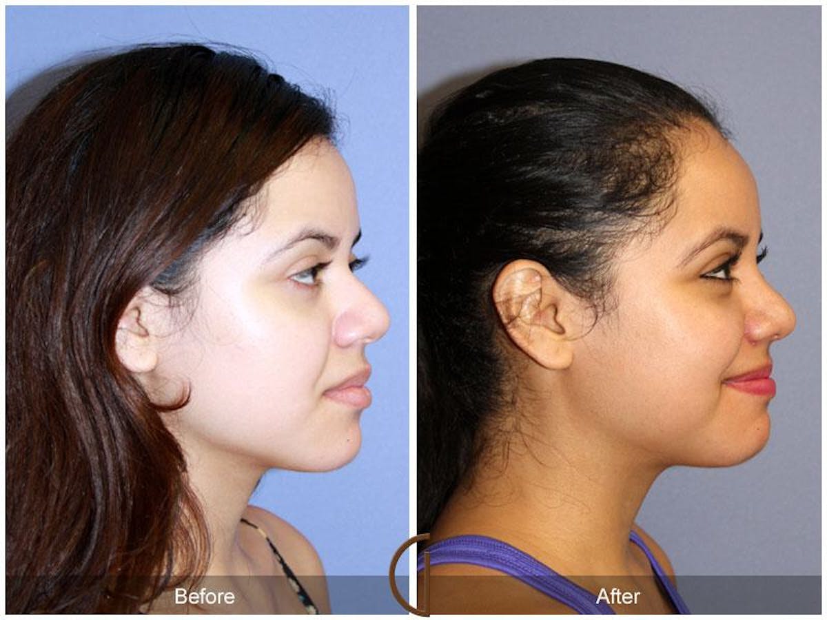 Female Rhinoplasty Before & After Gallery - Patient 146976 - Image 3