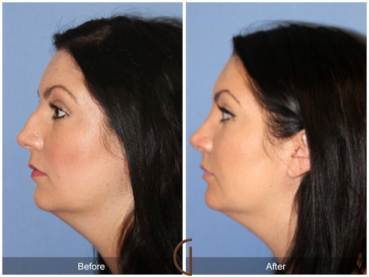 Female Rhinoplasty Before & After Gallery - Patient 332648 - Image 1
