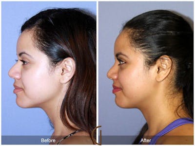 Female Rhinoplasty Before & After Gallery - Patient 146976 - Image 1