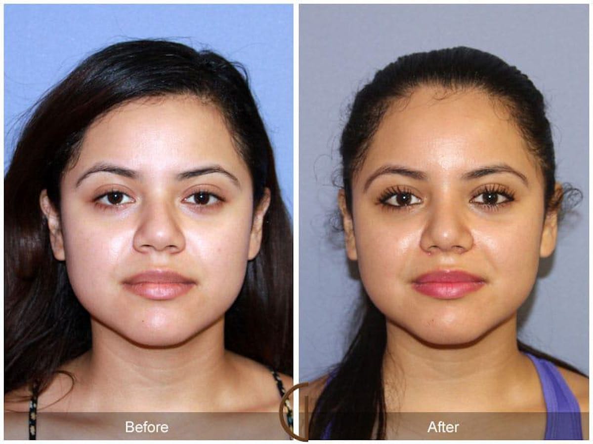 Female Rhinoplasty Before & After Gallery - Patient 146976 - Image 2