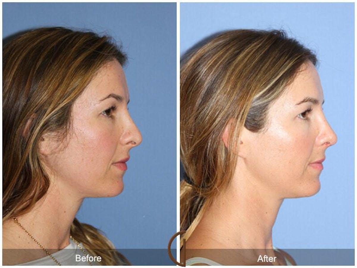 Female Rhinoplasty Before & After Gallery - Patient 257285 - Image 3