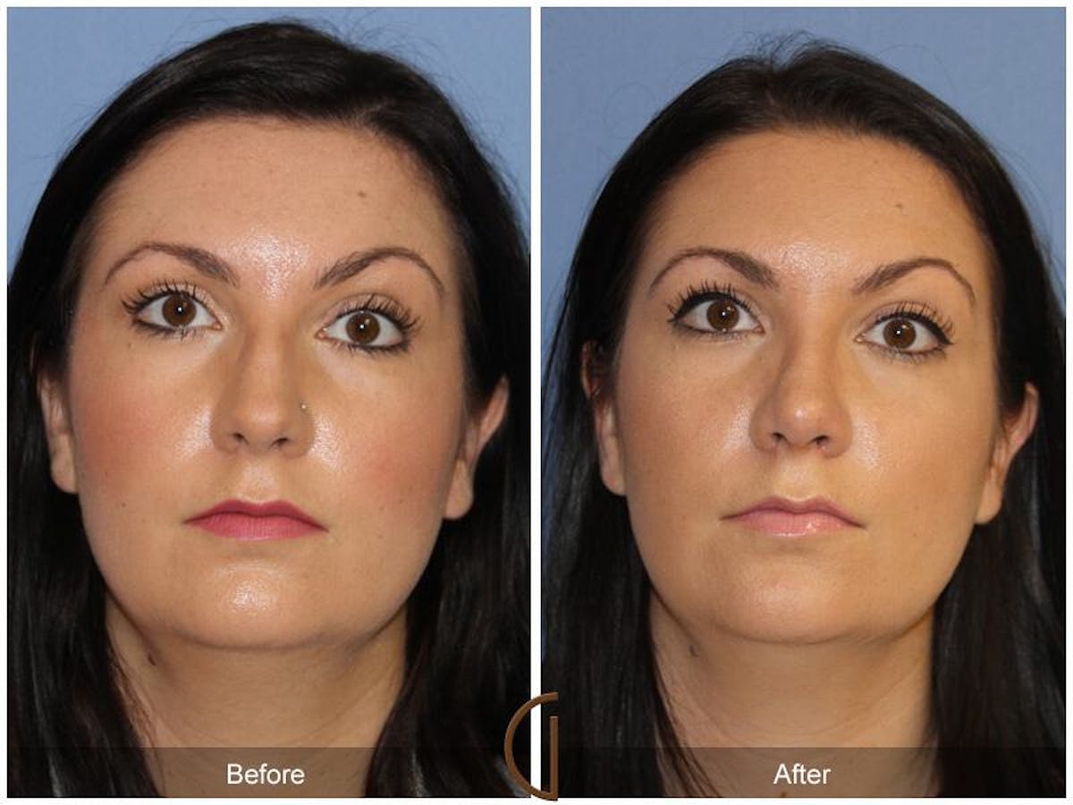 Female Rhinoplasty Before & After Gallery - Patient 332648 - Image 2
