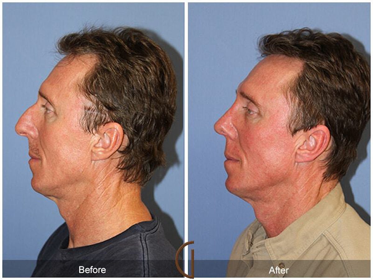 Rhinoplasty Before & After Gallery - Patient 370918 - Image 1